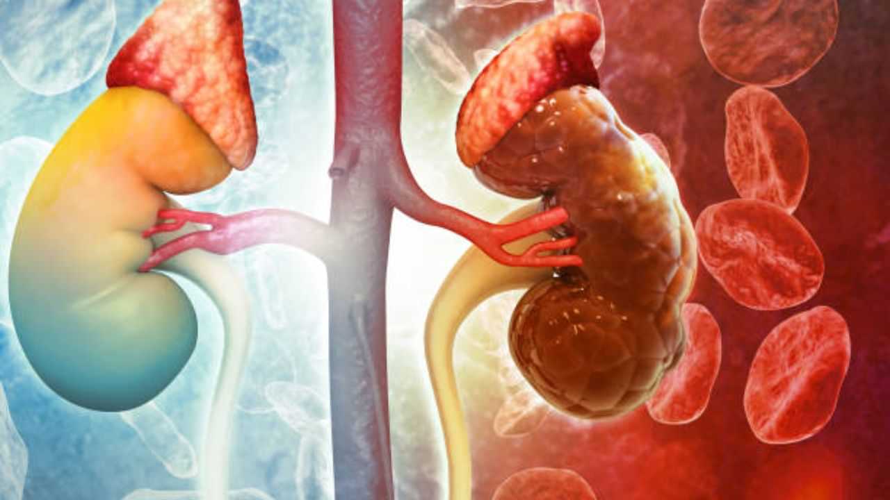 Kidney Cancer : கிட்னி கேன்சர்.. இந்த பிரச்னை எல்லாம் உங்கள் சிறுநீரகத்தை பாதிக்கும்!