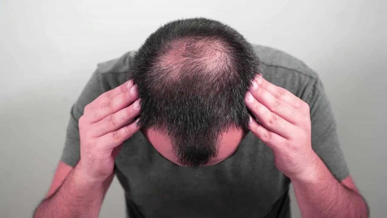 Hair Regrowth: வழுக்கை எதனால் விழுகிறது..? முடி வளர இதை பண்ணுங்க..