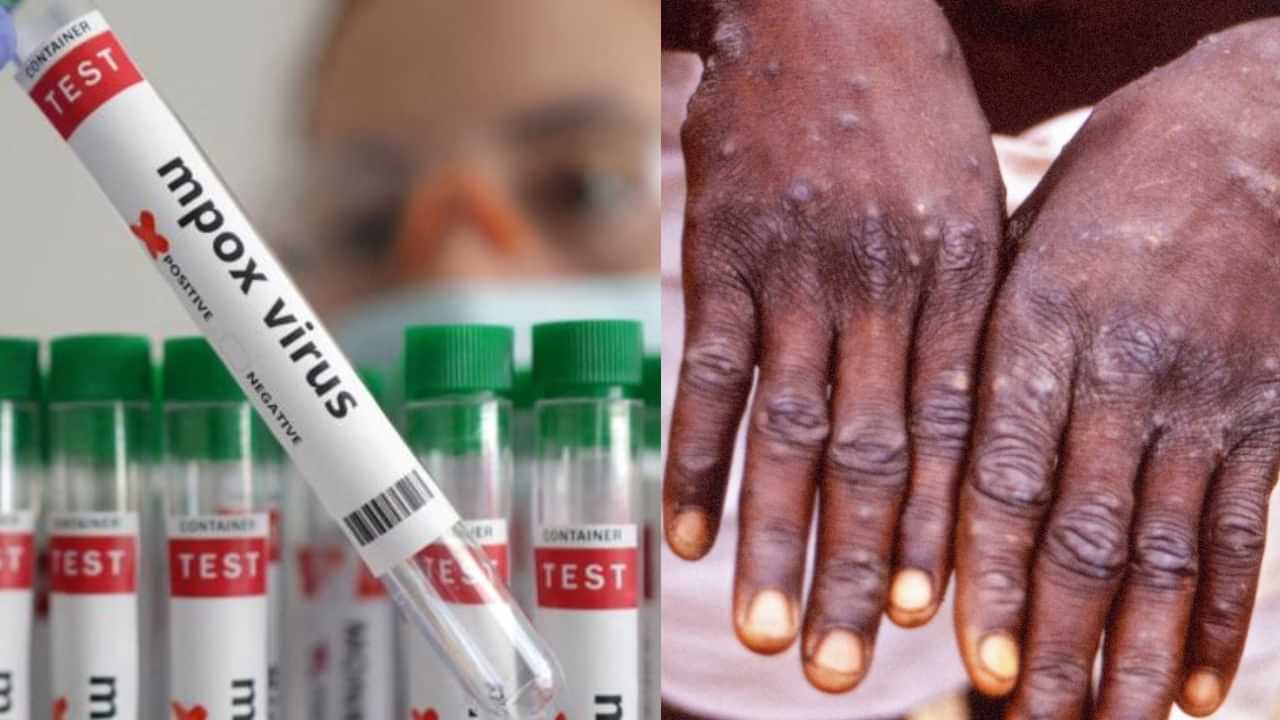 Monkey Pox: இந்தியாவில் முதல் குரங்கு அம்மை பாதிப்பு? இந்த அறிகுறிகள் இருந்தால் உடனே மருத்துவமனை போங்க!