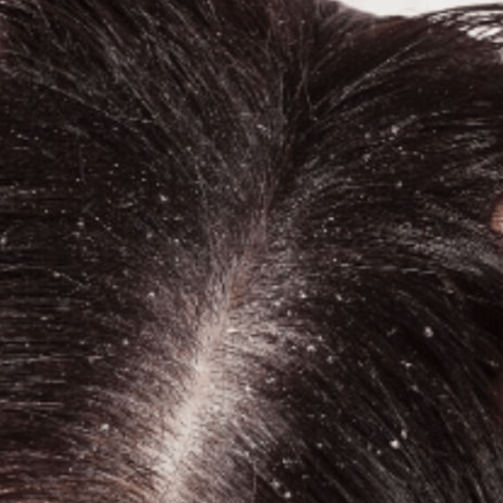 dandruff 5