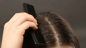 Dandruff Control: பொடுகு தொல்லையால் அவதியா? இந்த முறையை செய்து பாருங்க!